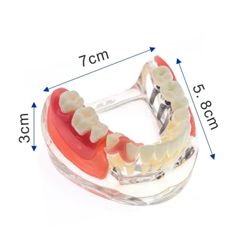 Модел на зъболекар с Имплантат с Реставрацией модел зъби Подвижна Мостовидный Протеза Обучение на изследователския модел за студенти стоматолози